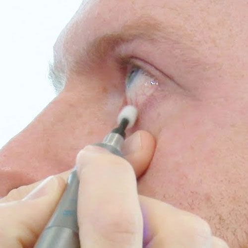 blepharitis treatment